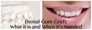 Ollerton Gum Graft