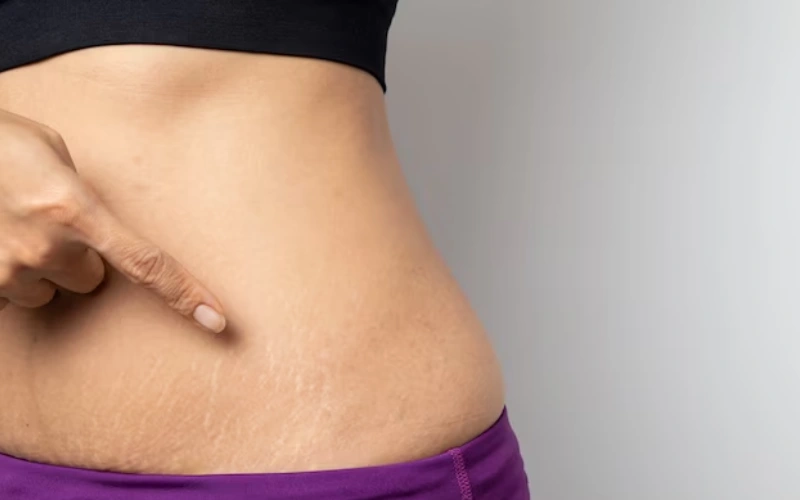 The Science Behind Stretch Mark Microneedling: A Closer Look